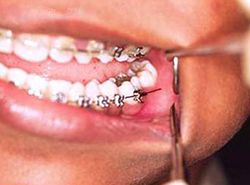 How to fix braces at home · Jamesburg NJ