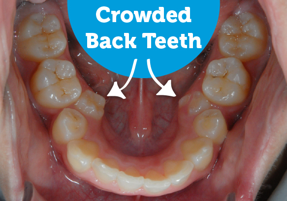 Before and after braces fix crowding back teeth