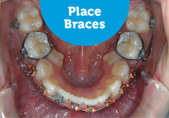teeth crowded braces fix straightening space place placed smile month