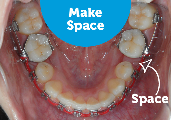 During braces make space for crooked teeth.