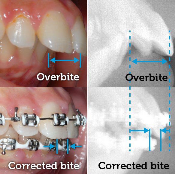 Overbite corrected with braces · South Brunswick NJ