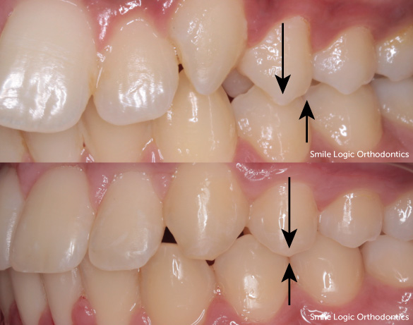 Overbite Correction - Before and After Photos